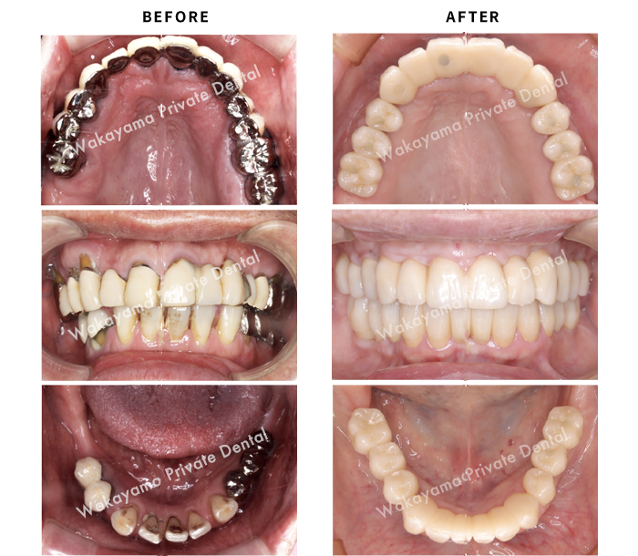 症例⑬ 30代女性・インプラントによる全顎治療