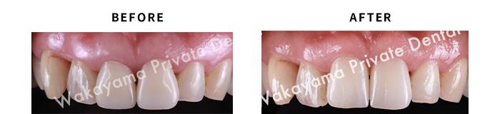 症例⑭ 30代女性・インプラントによる前歯治療